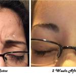 BOTOX treatments