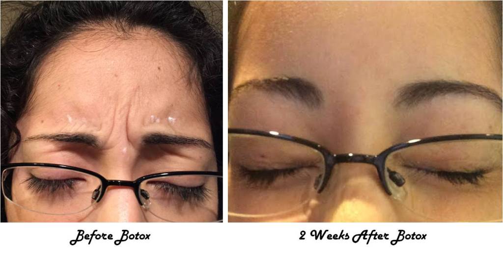 BOTOX treatments