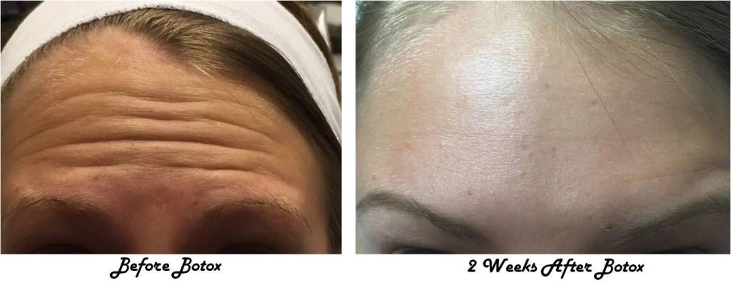 BOTOX treatments