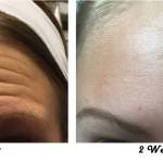 BOTOX treatments