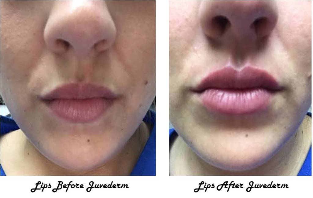 Juvederm applied to lips, before and after