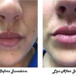 Juvederm applied to lips, before and after