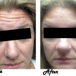 Botox applied to forehead, before and after
