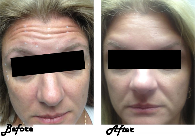 Botox applied to forehead, before and after