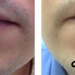 lip piercing healed, before and after