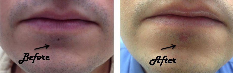 lip piercing healed, before and after