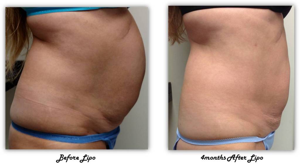 Before and after liposuction