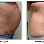Before and after liposuction