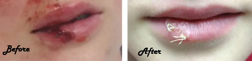 lip laceratoin healed, before and after