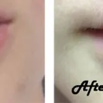 lip laceratoin healed, before and after