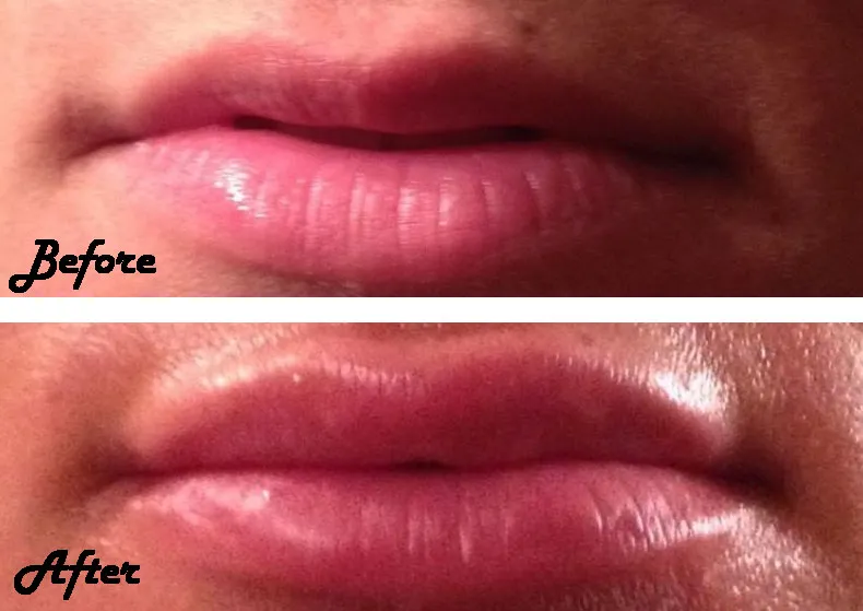 Juvederm applied to lips, before and after