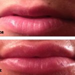 Juvederm applied to lips, before and after