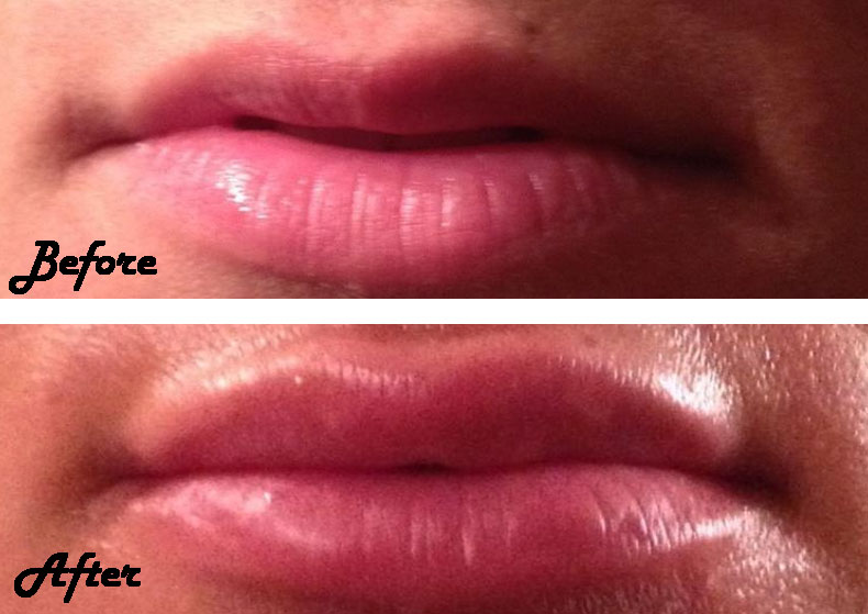 Juvederm applied to lips, before and after