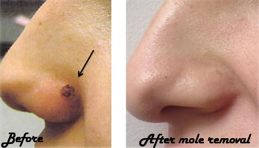 nose mole removed, before and after