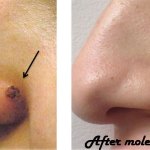 nose mole removed, before and after