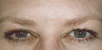 Botox Cosmetic, after