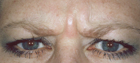 Botox Cosmetic, before