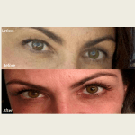 BOTOX treatments
