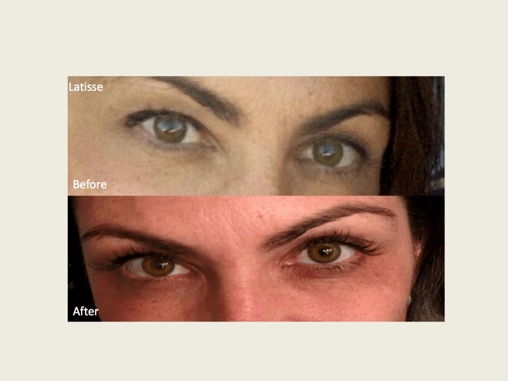 BOTOX treatments
