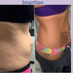 Before and after liposuction