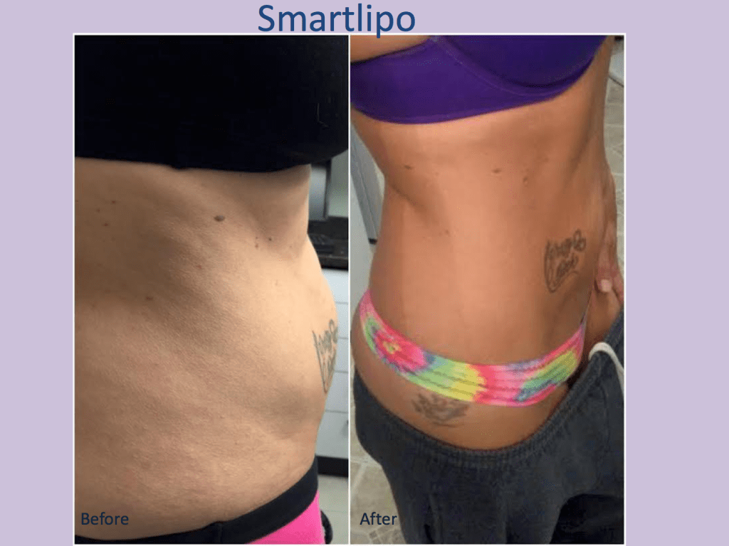 Before and after liposuction