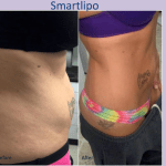 Before and after liposuction