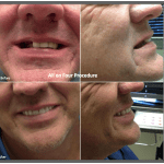 All-on-4® treatment concept