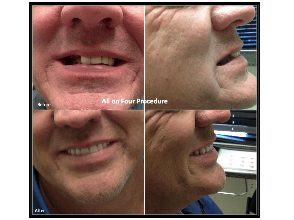 All-on-4® treatment concept