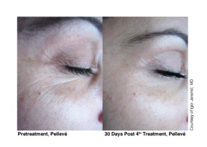 Skin Tightening with Pellevé treatment