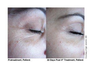 Skin Tightening with Pellevé treatment